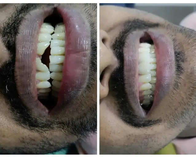 Smile Transformation Case 1