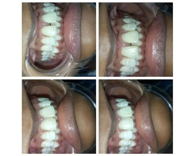 Smile Transformation Case 2