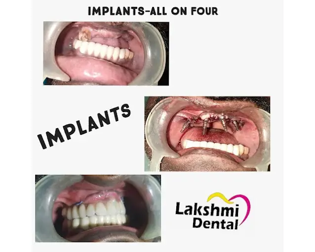 Smile Transformation Case 3