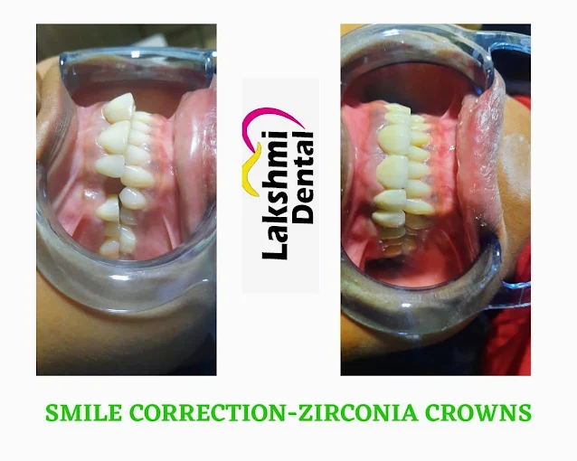 Smile Transformation Case 4